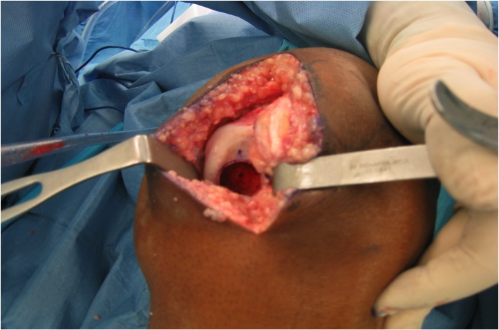 Osteochondral Allograft Pre